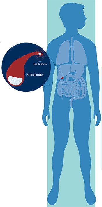 Gallbladder Stones